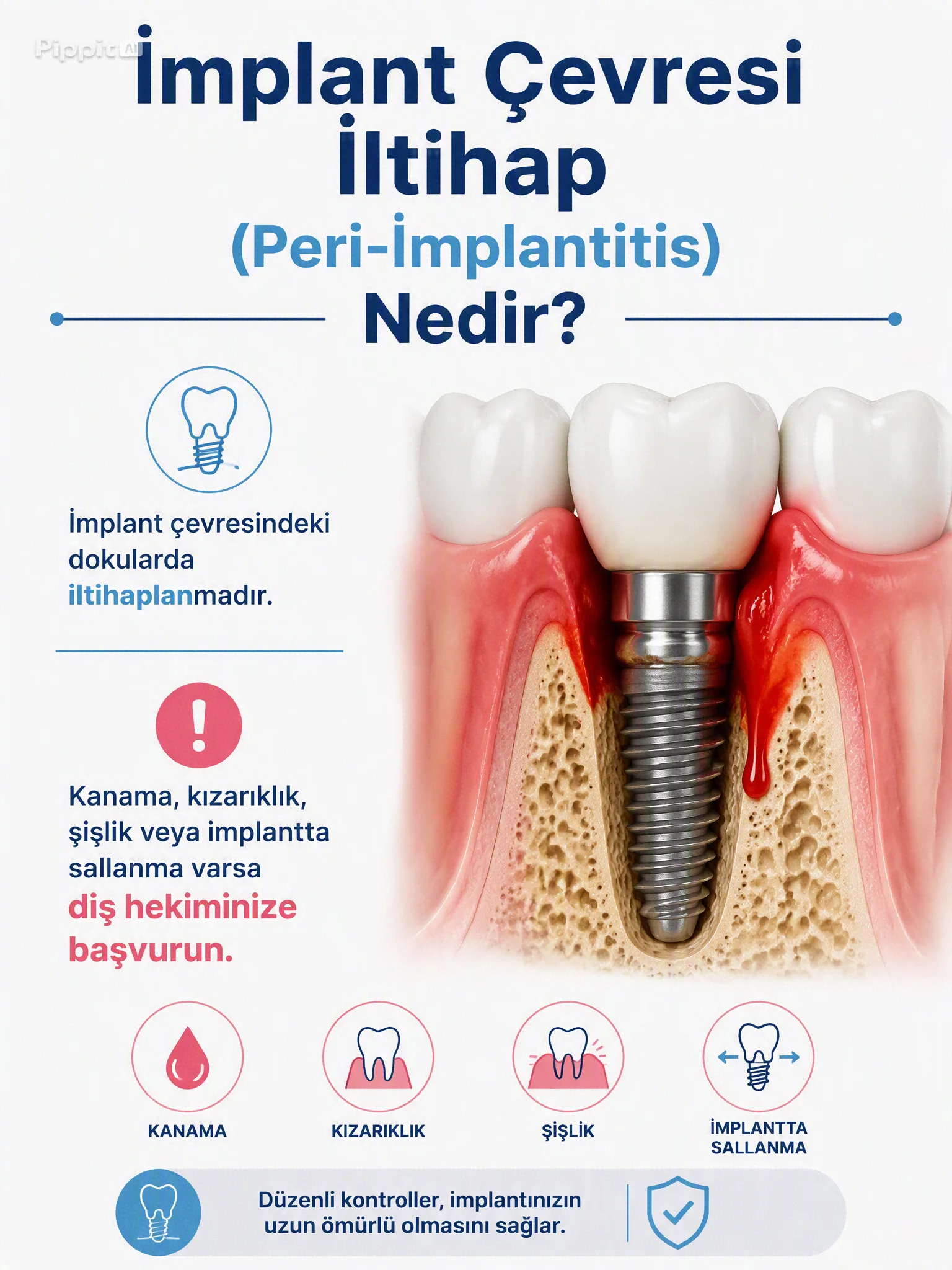İmplant Çevresi İltihap (Peri-İmplantitis) Nedir? İmplantımı Kaybetmeden Nasıl Kurtarırım?