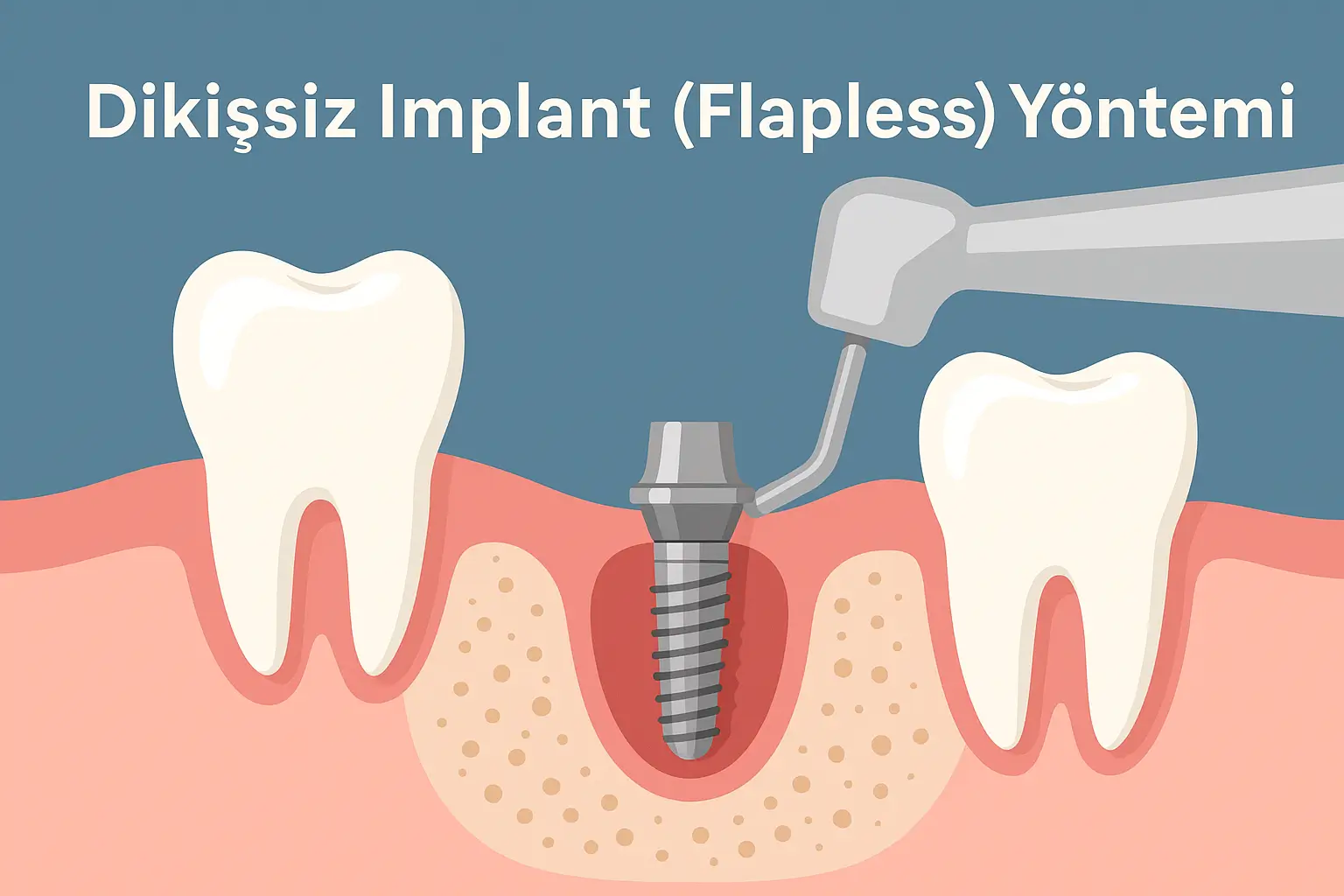 Dikişsiz implant