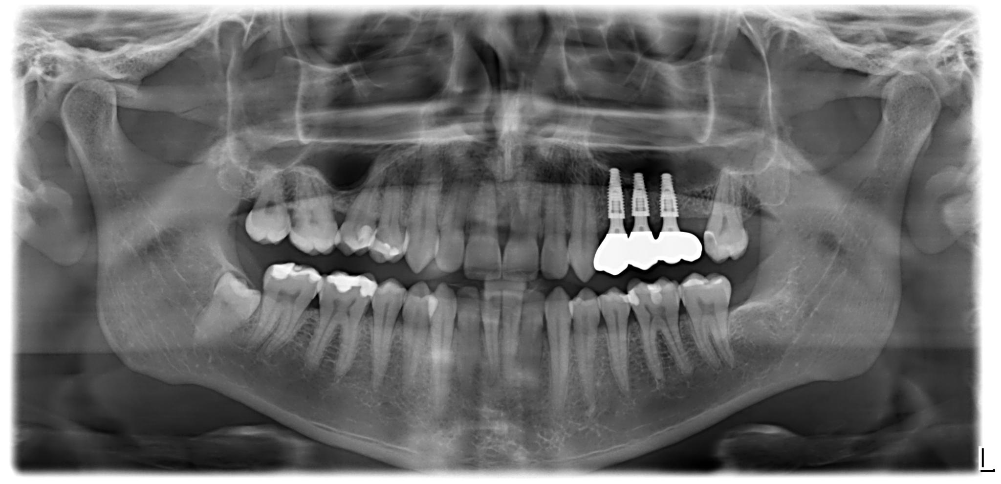 Dikişsiz implant