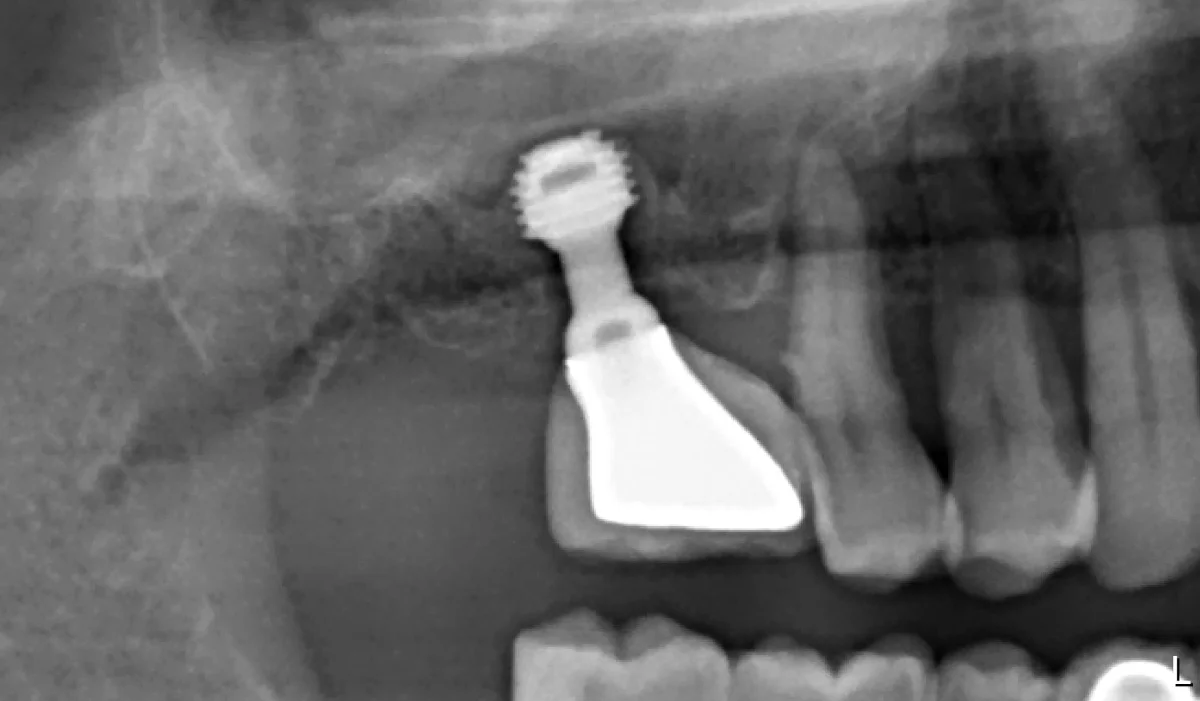 Kısa implant