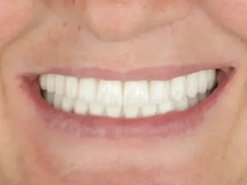 Zirkonyum Kaplama