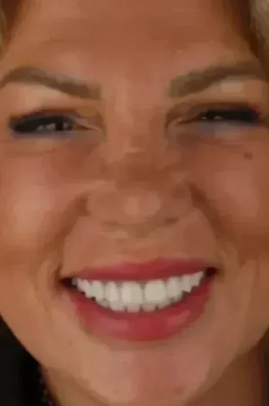 Gülüş Tasarımı (Hollywood Smile)