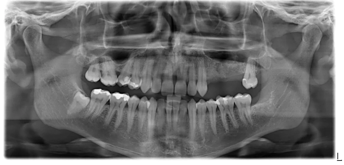 Dikişsiz implant - Klinik Kayıt