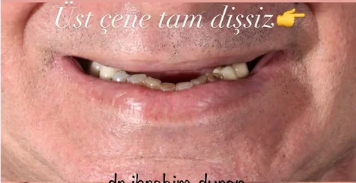 Diş İmplantı - Klinik Kayıt