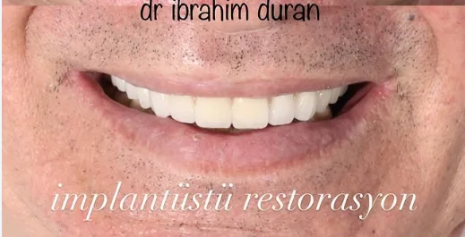 Diş İmplantı