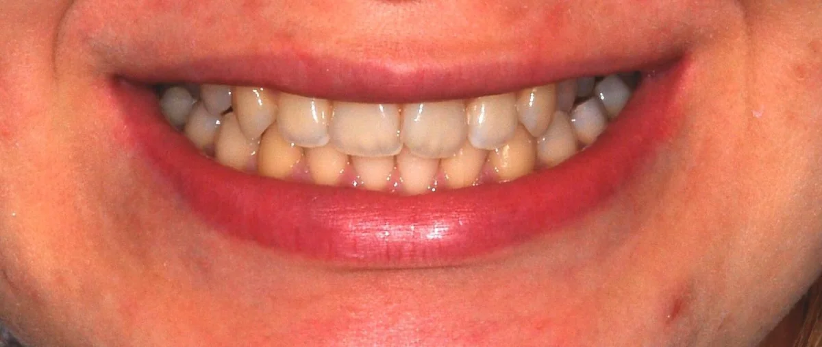 Diş Beyazlatma (Bleaching) - Klinik Kayıt